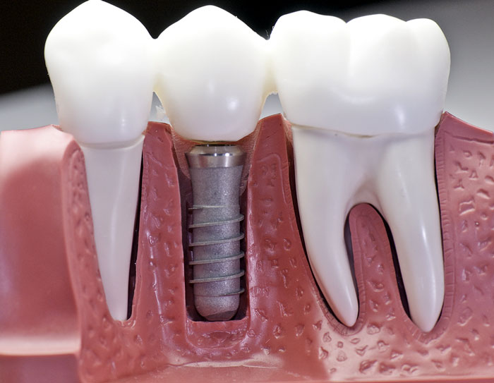 servicios de implantología en clinica dental alcudia . implantes dentales inmediatos